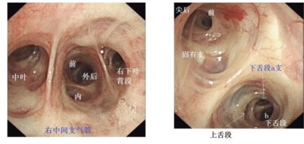 leyu.体育(中国)官方网站7步教你掌握支气管肺泡灌洗术！建议收藏(图1)